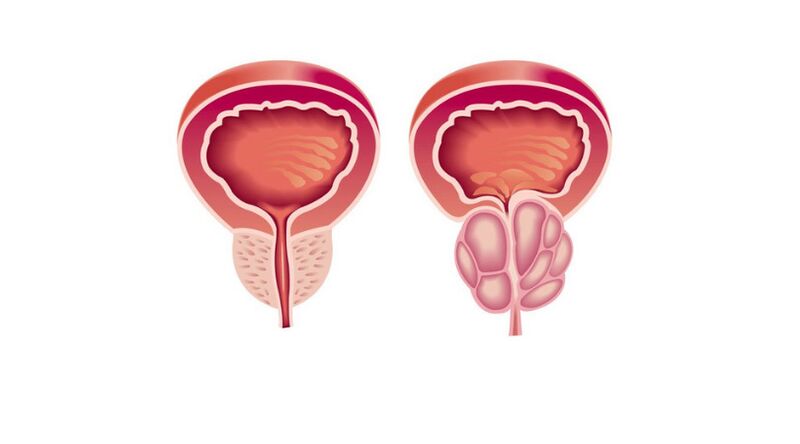 comparison between normal and diseased prostate